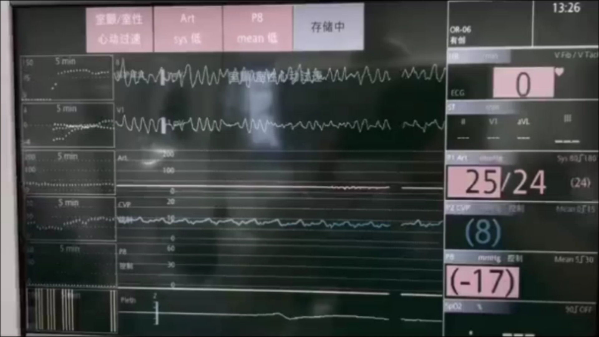 心电监护仪室颤电除颤哔哩哔哩bilibili