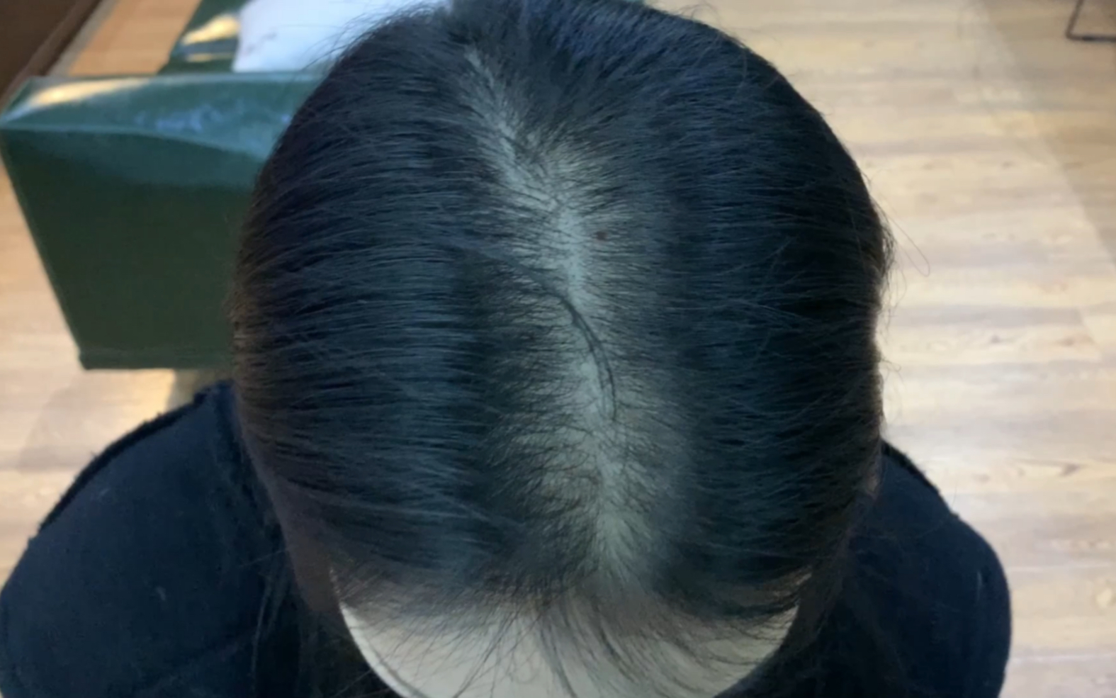 今年19岁,这样的秃顶还有的救吗?