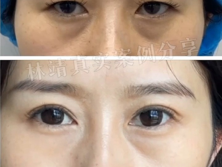 重睑术后4个月对比[玫瑰] 术前眼皮耷拉着,眼睛空洞无神;术后成形自然
