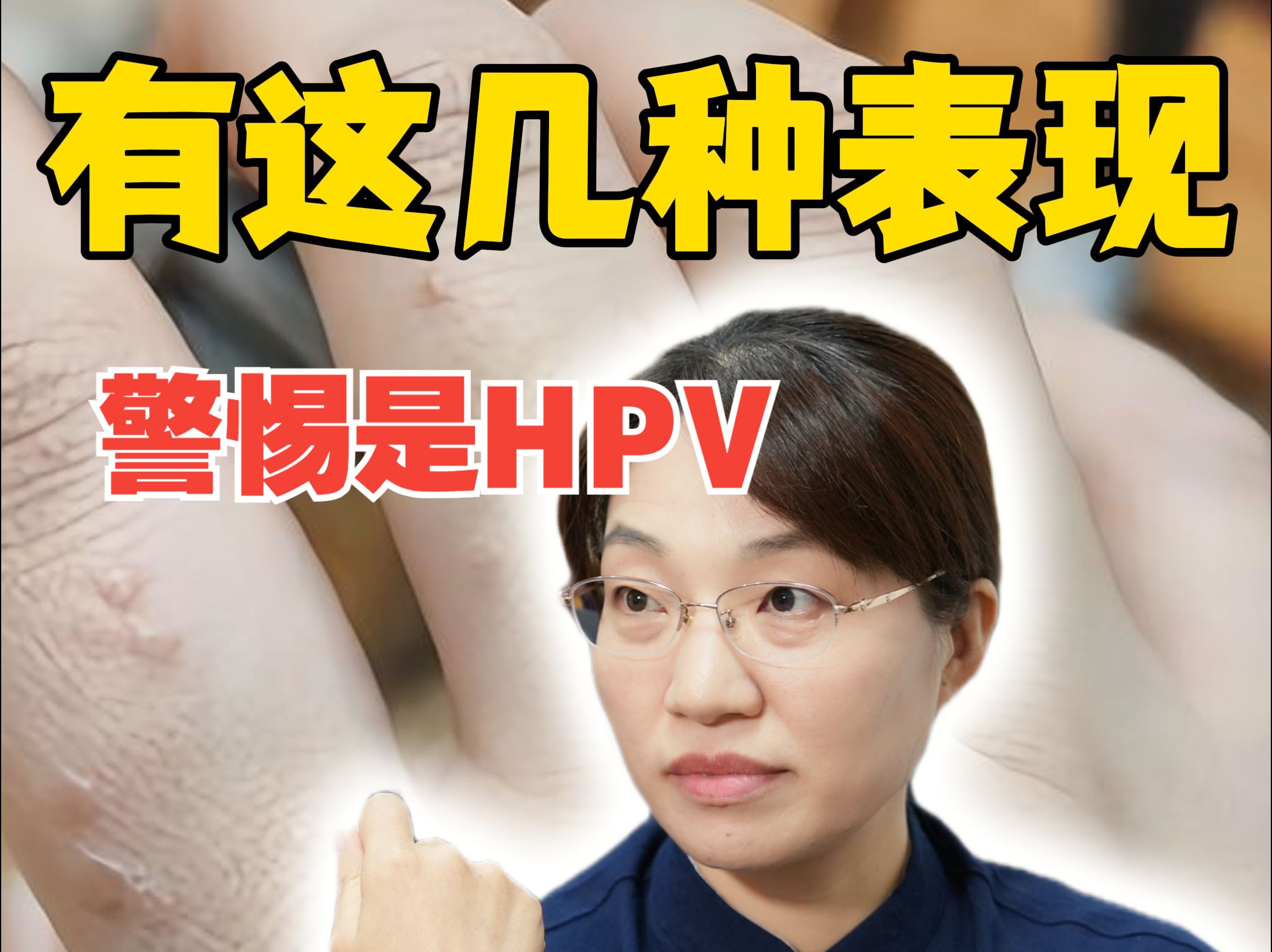 身上这3种表现,肯是得了hpv!哔哩哔哩bilibili