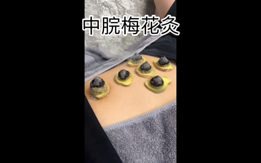 自制倒流烟艾塔做中脘梅花灸,脾胃