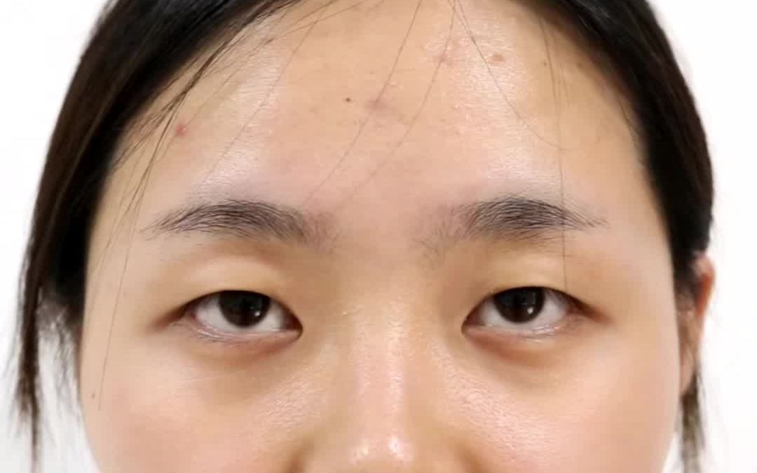 【单眼皮】眼皮松弛,眼睛没神 改善恢复过程_哔哩哔哩_bilibili