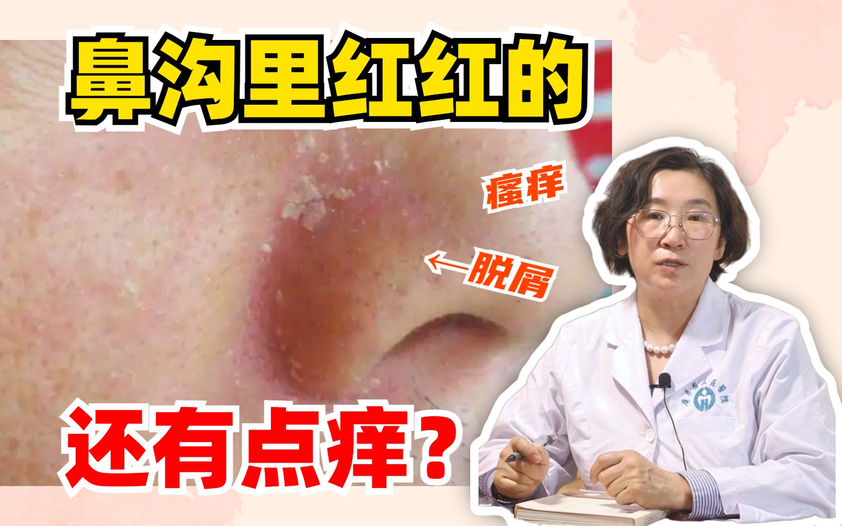 鼻子两侧沟沟里红红的,又油又痒还脱屑,脂溢性皮炎怎么办?
