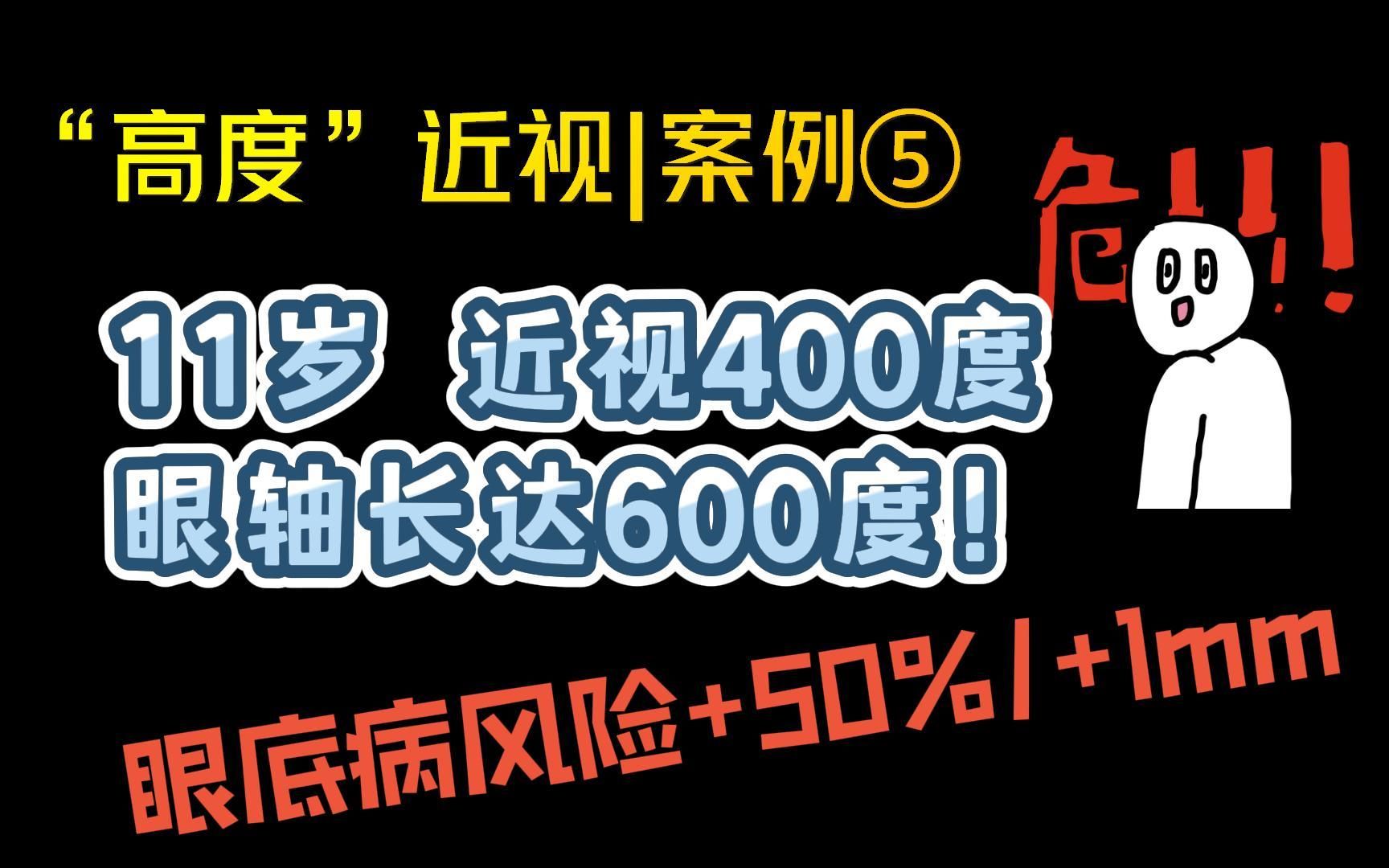 隐性近视|典例⑤:11岁,近视400,眼轴600,远比你想象中危险!哔哩哔哩bilibili