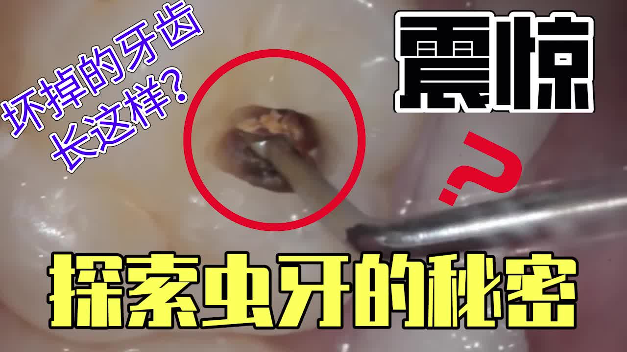 【高清】探索虫牙的秘密,原来坏掉的牙齿长这样子?