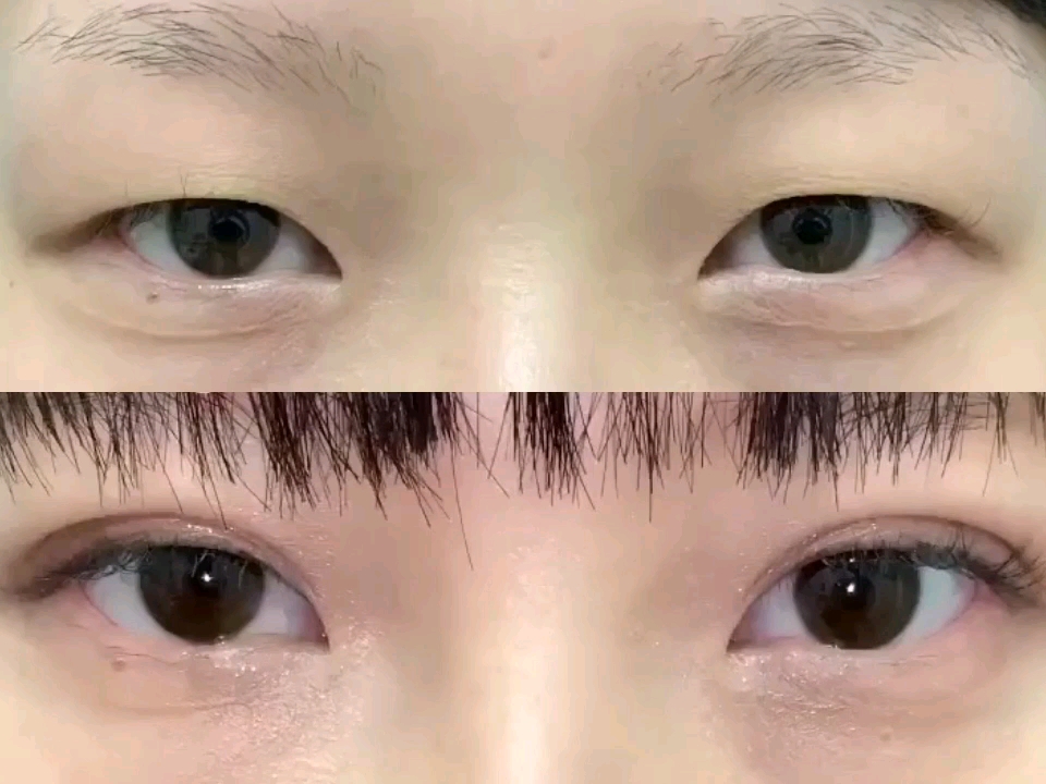 肿眼泡仙女的无痕埋线双眼皮脱脂