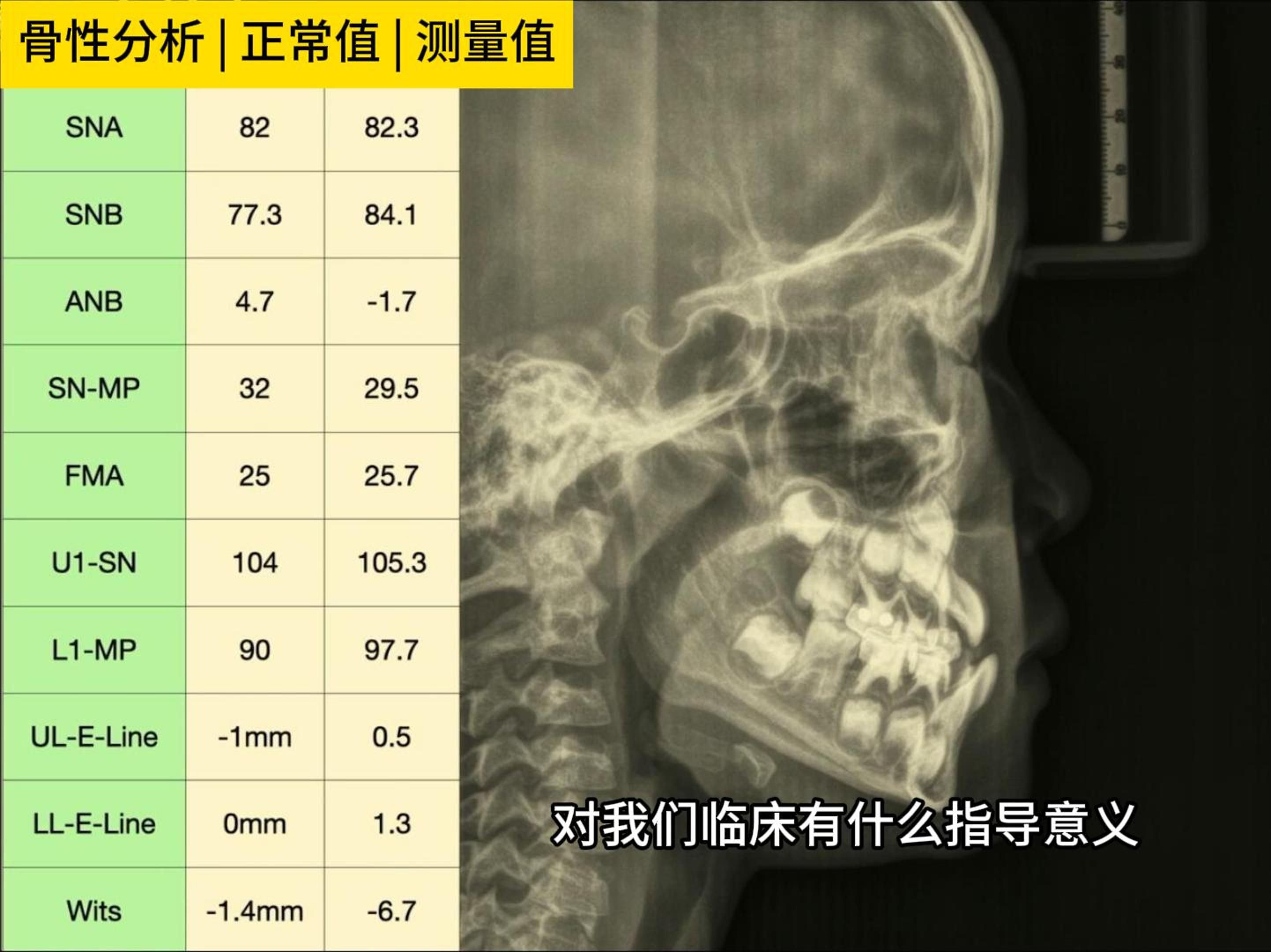 儿牙早期矫治的检查与资料收集哔哩哔哩bilibili