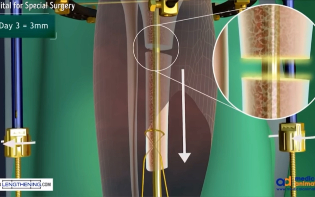 [图]腿骨手术动画演示