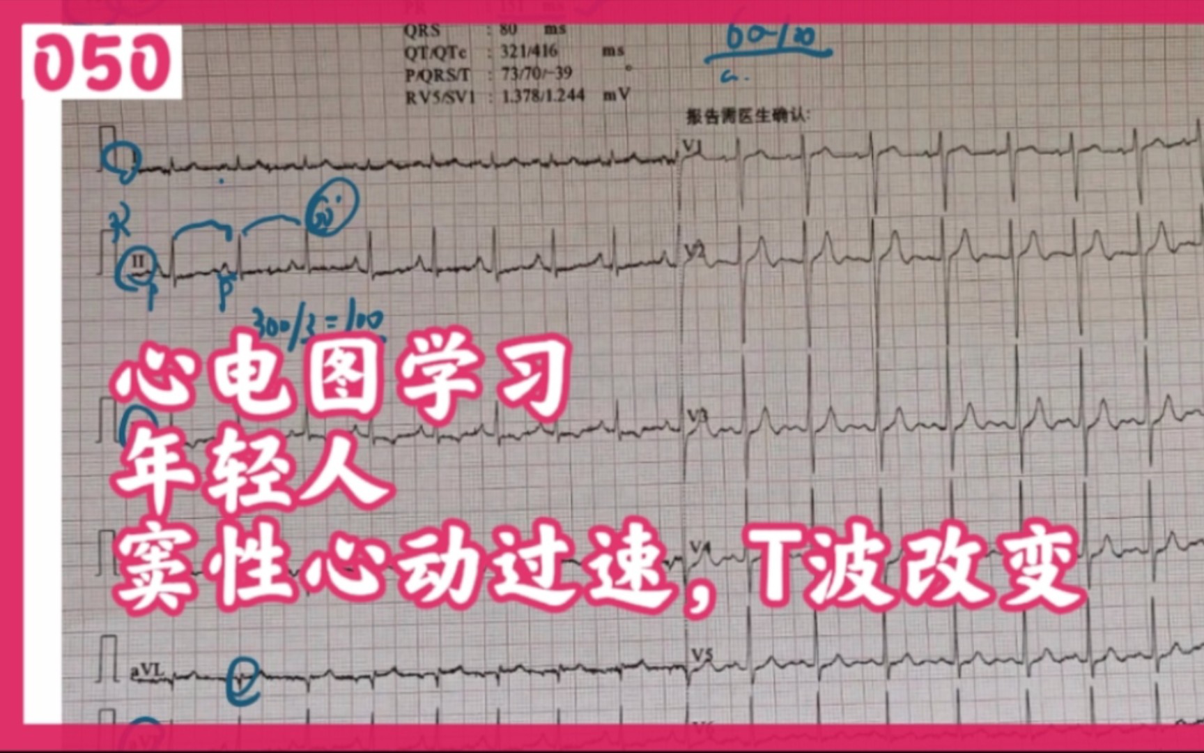 心电图学习,窦性心动过速,T波改变哔哩哔哩bilibili