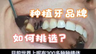 种植牙品牌那么多？我该怎么选？国产好还是欧美好还是韩国好？