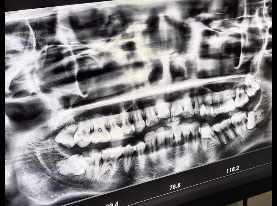 矫正牙齿十年后竟然又歪了?都是智齿惹得祸!公立医院全麻拔四颗 ,想拔智齿的可以了解喔哔哩哔哩bilibili