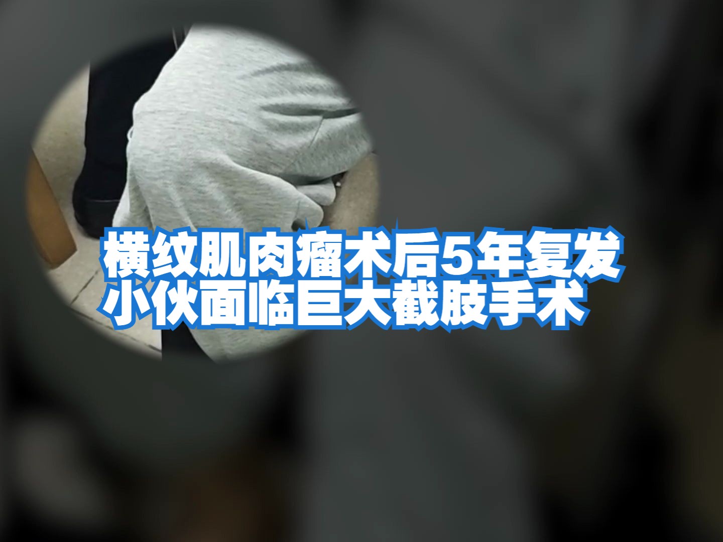 痛心!28岁横纹肌肉瘤患者外院术后5年,腹股沟处已复发1年多,肿瘤生长巨大,面临截肢!哔哩哔哩bilibili