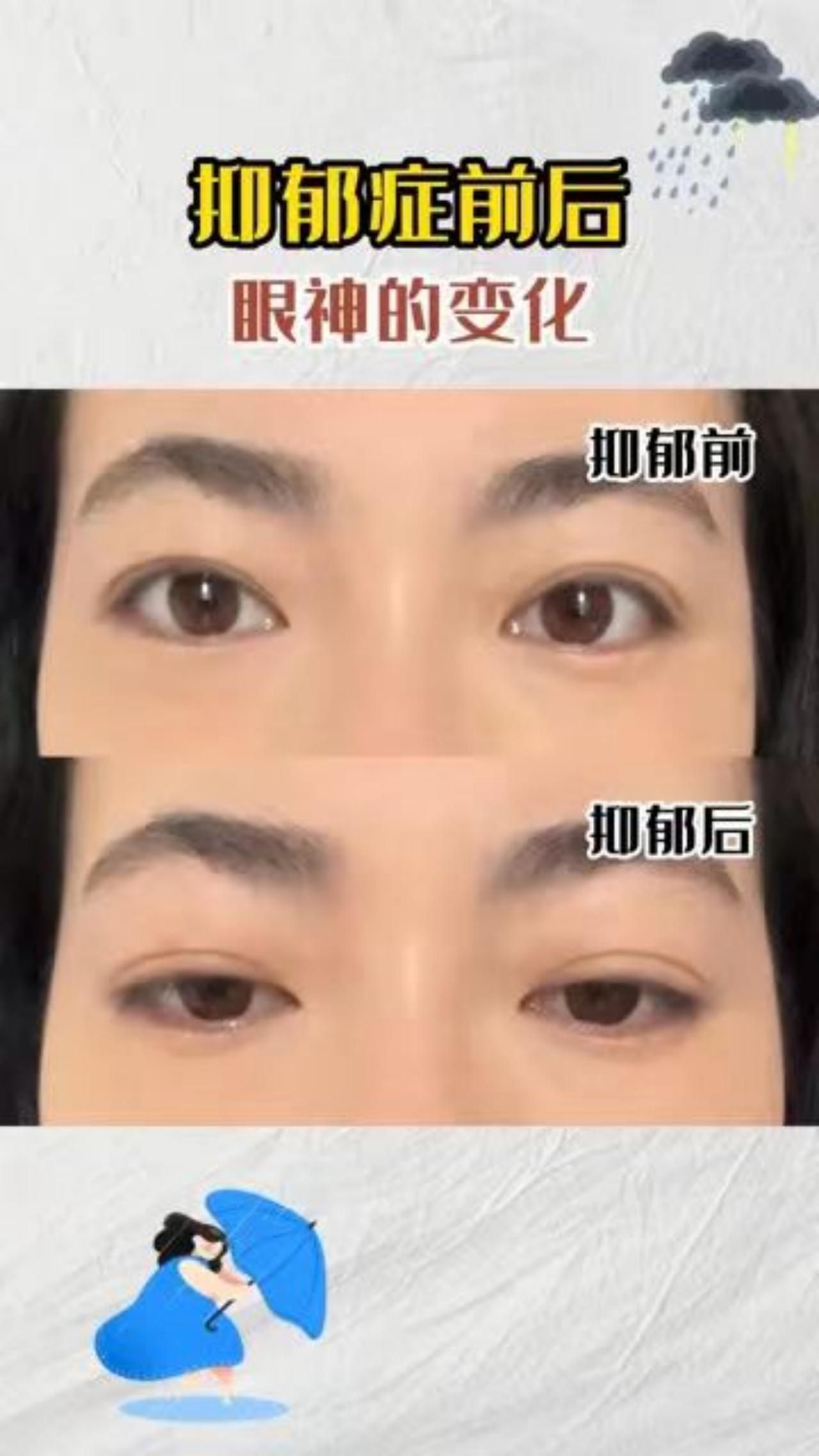 抑郁症前后,眼神的变化