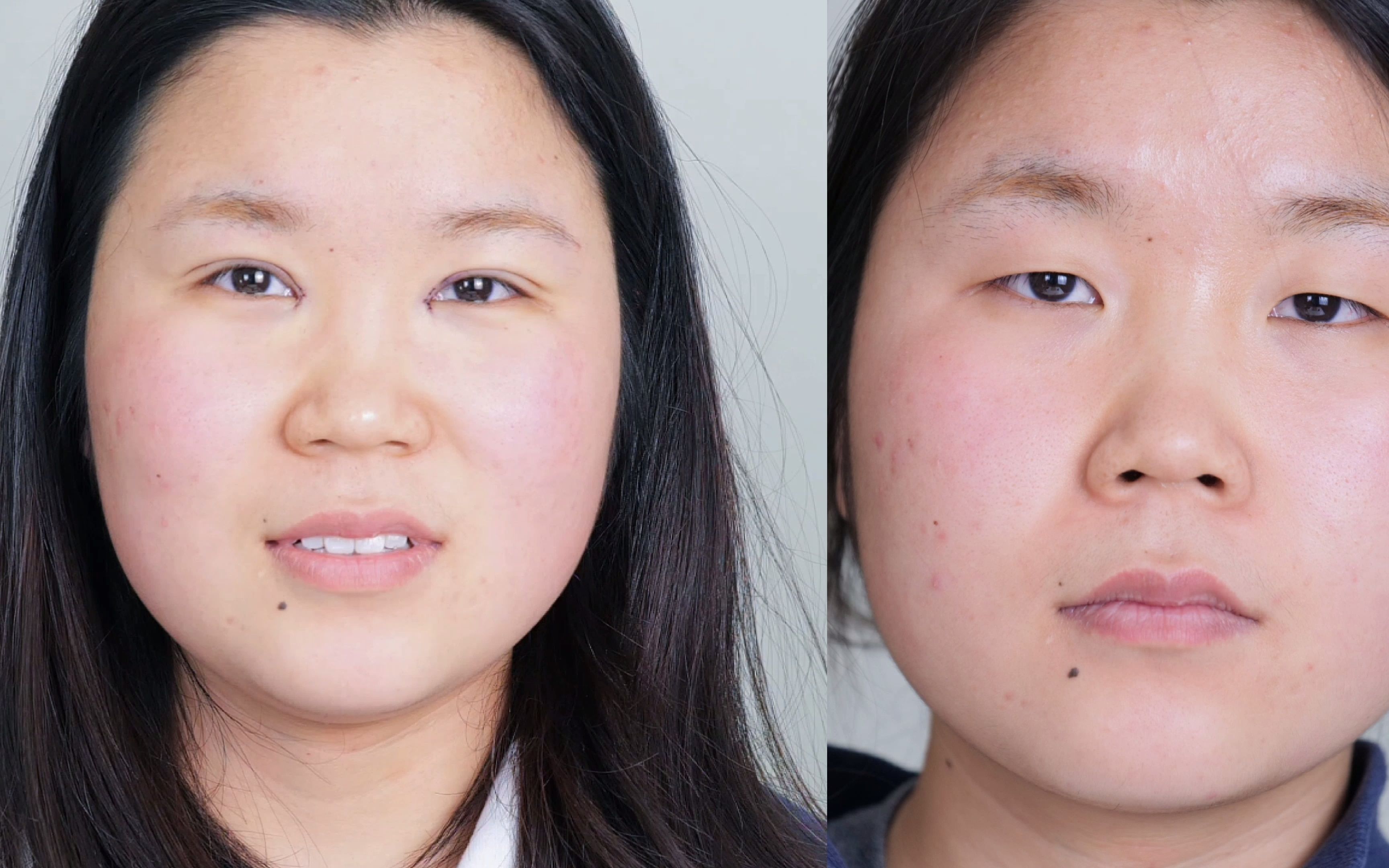 眼睛笑起来像小蝌蚪的初眼做双眼皮后是什么样子?