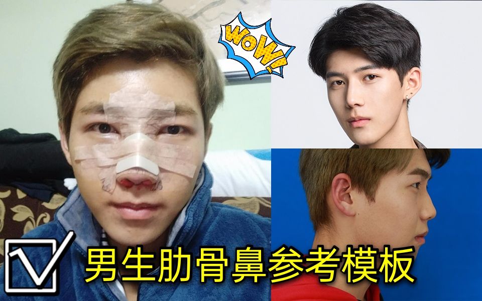男生肋骨鼻参考丨肿成猪头帅成风云学长
