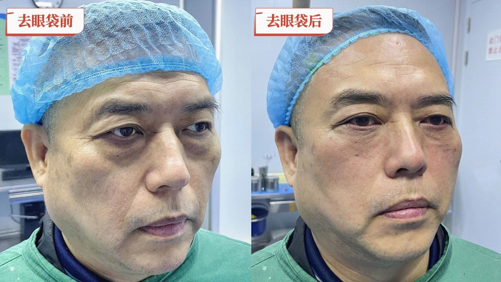 55岁做眼袋手术,40分钟后看着镜子不撒手,激动说满意!年轻了!