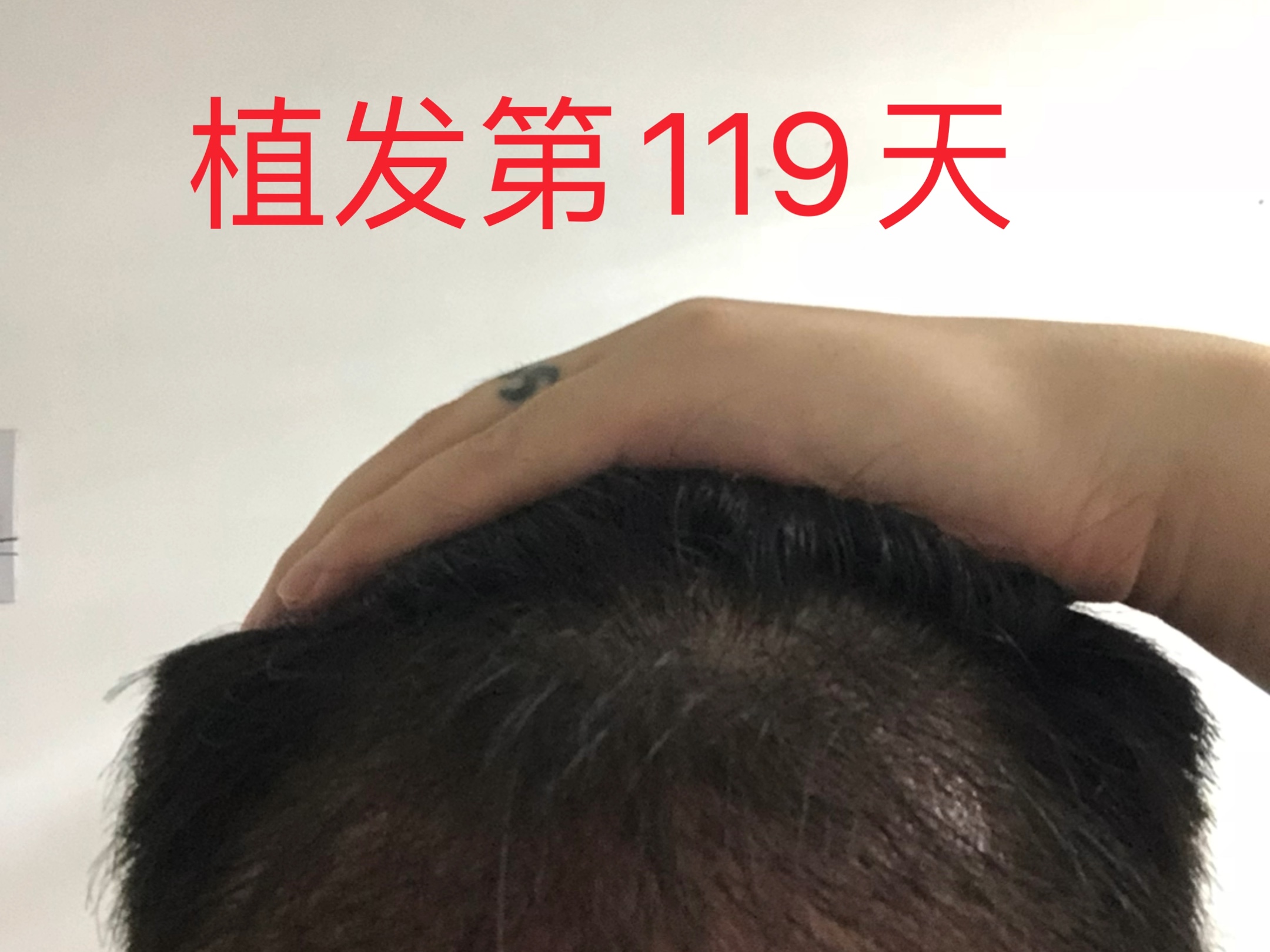 植发换算单位(植发1600单位)
