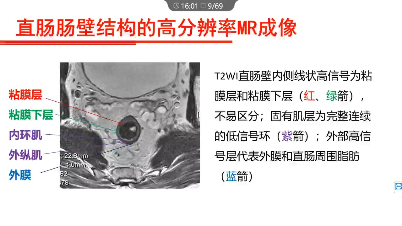 直肠癌MRI多维度评价王培军哔哩哔哩bilibili