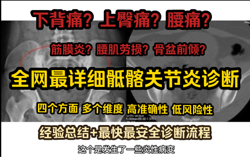 全网最详细:关于骶髂关节炎如何诊断(适用骶髂关节不适患者及康复从业者)哔哩哔哩bilibili