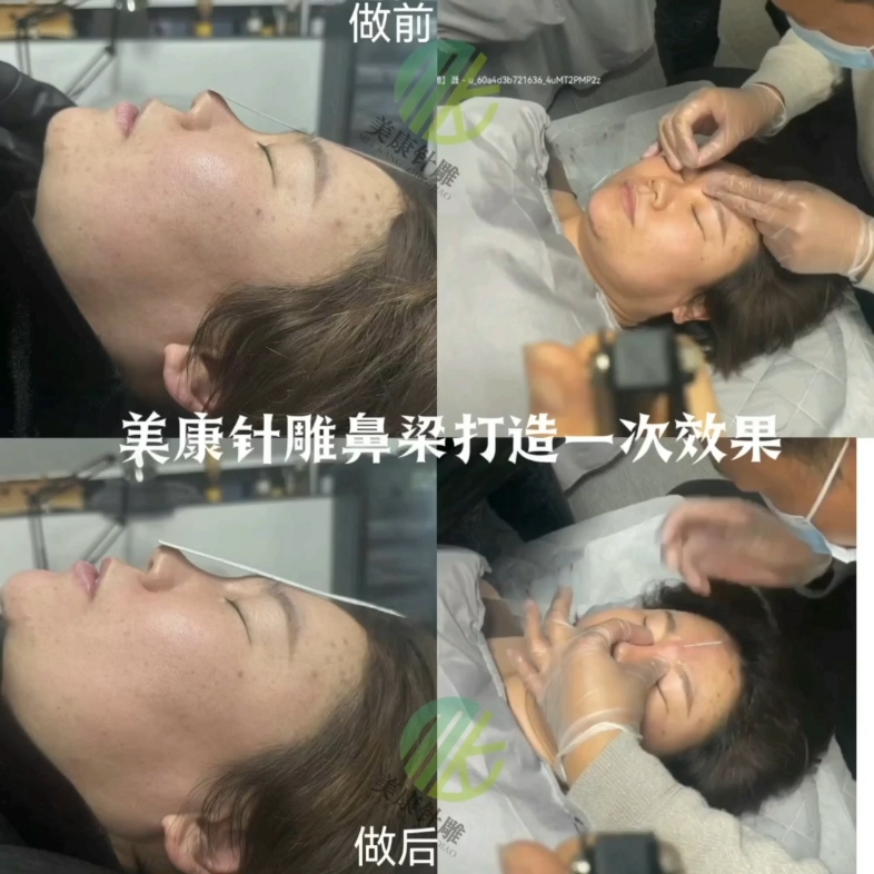 中医针灸美雕起源—郑州美康针雕