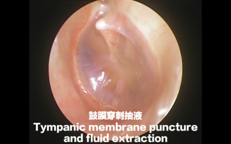 鼓膜穿刺抽液Tympanic membrane puncture and fluid extraction哔哩哔哩bilibili