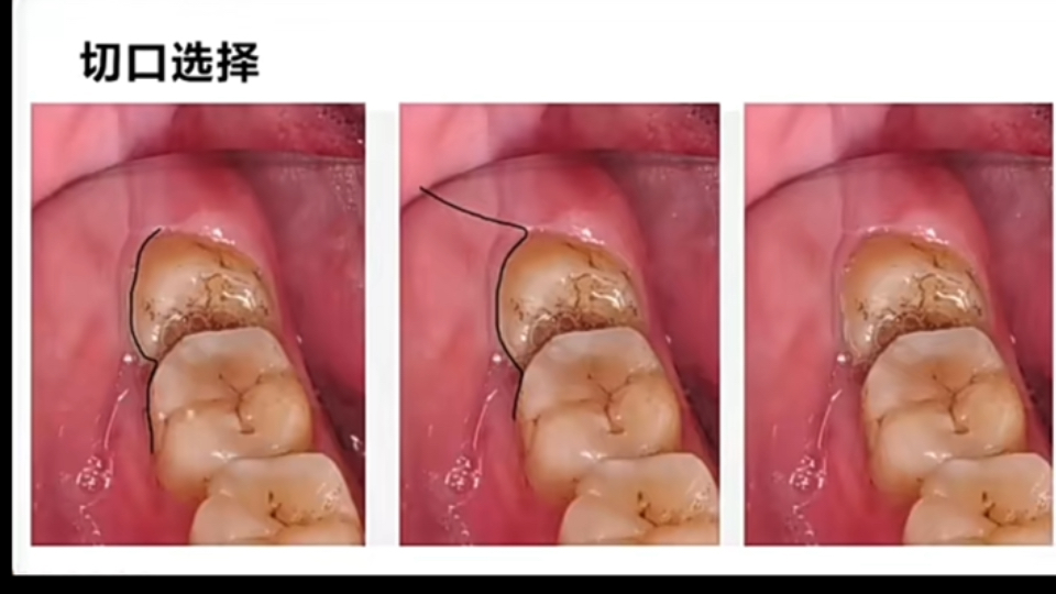 下颌近中阻生齿拔除01