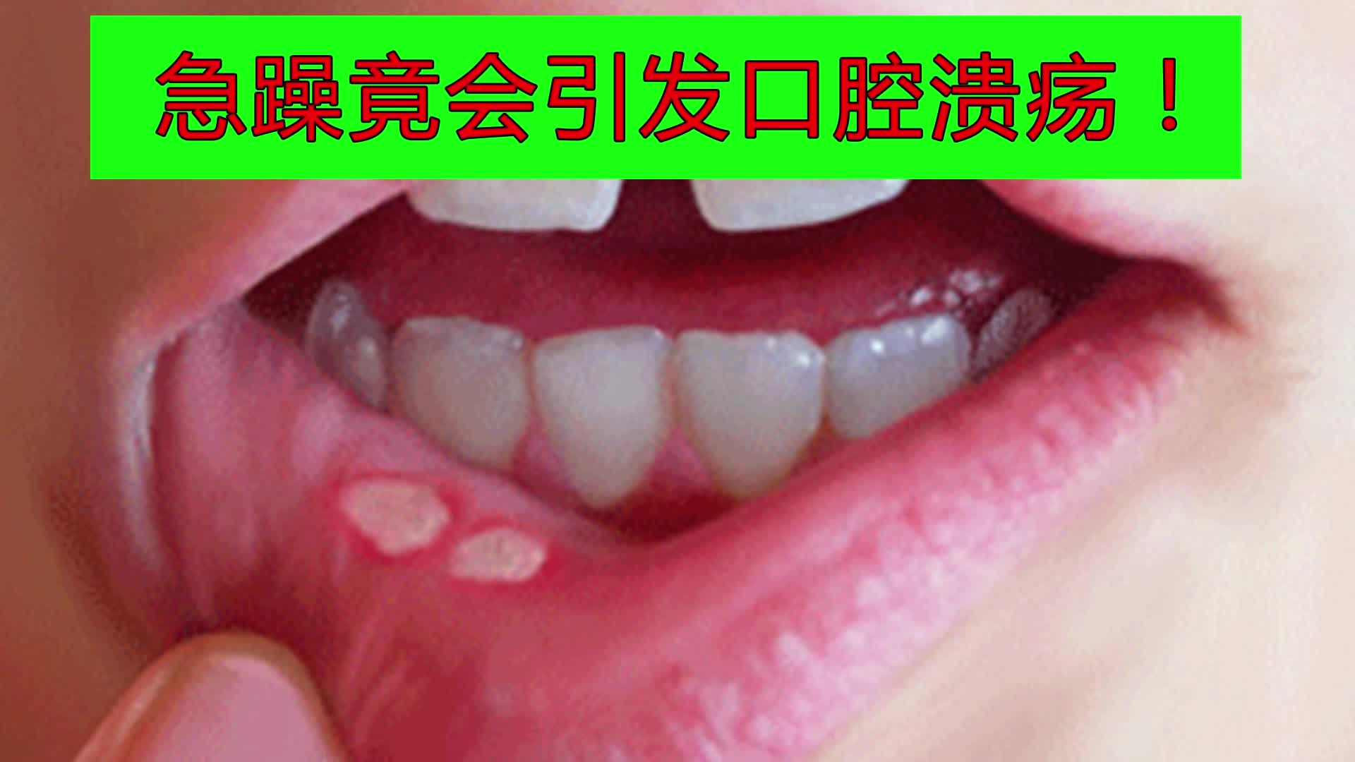 為什麼你經常得口腔潰瘍?看完就知道了!