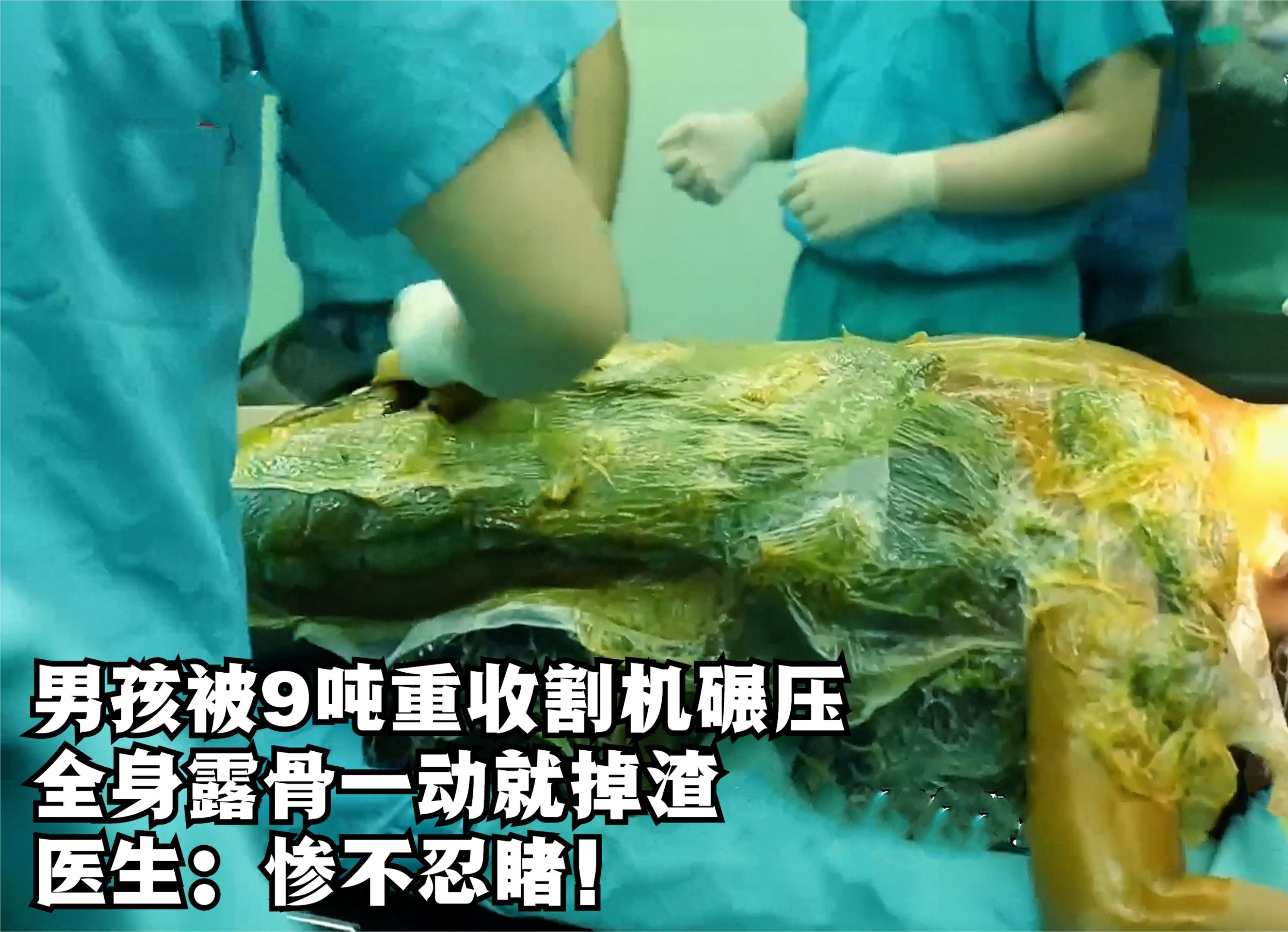 男孩被9吨重收割机碾压,全身露骨一动就掉渣,医生:惨不忍睹