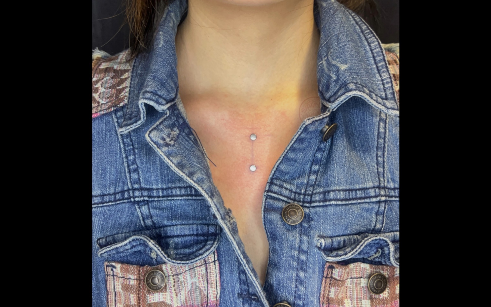 直角埋钉 穿刺过程 有被丝滑倒 全程一分钟不到拥有美丽的直角埋钉