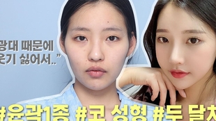 整形vlog 隆鼻 轮廓手术 颧骨 下颌骨 改善鼻头下垂 矫正不对称 哔哩哔哩 つロ干杯 Bilibili