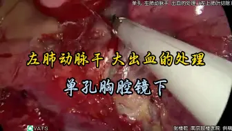 单孔胸腔镜 左肺动脉干 大出血的处理（张楼乾教授供稿-南京鼓楼医院）
