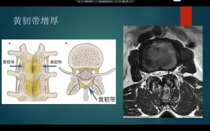 Download Video: 腰椎磁共振基础影像诊断