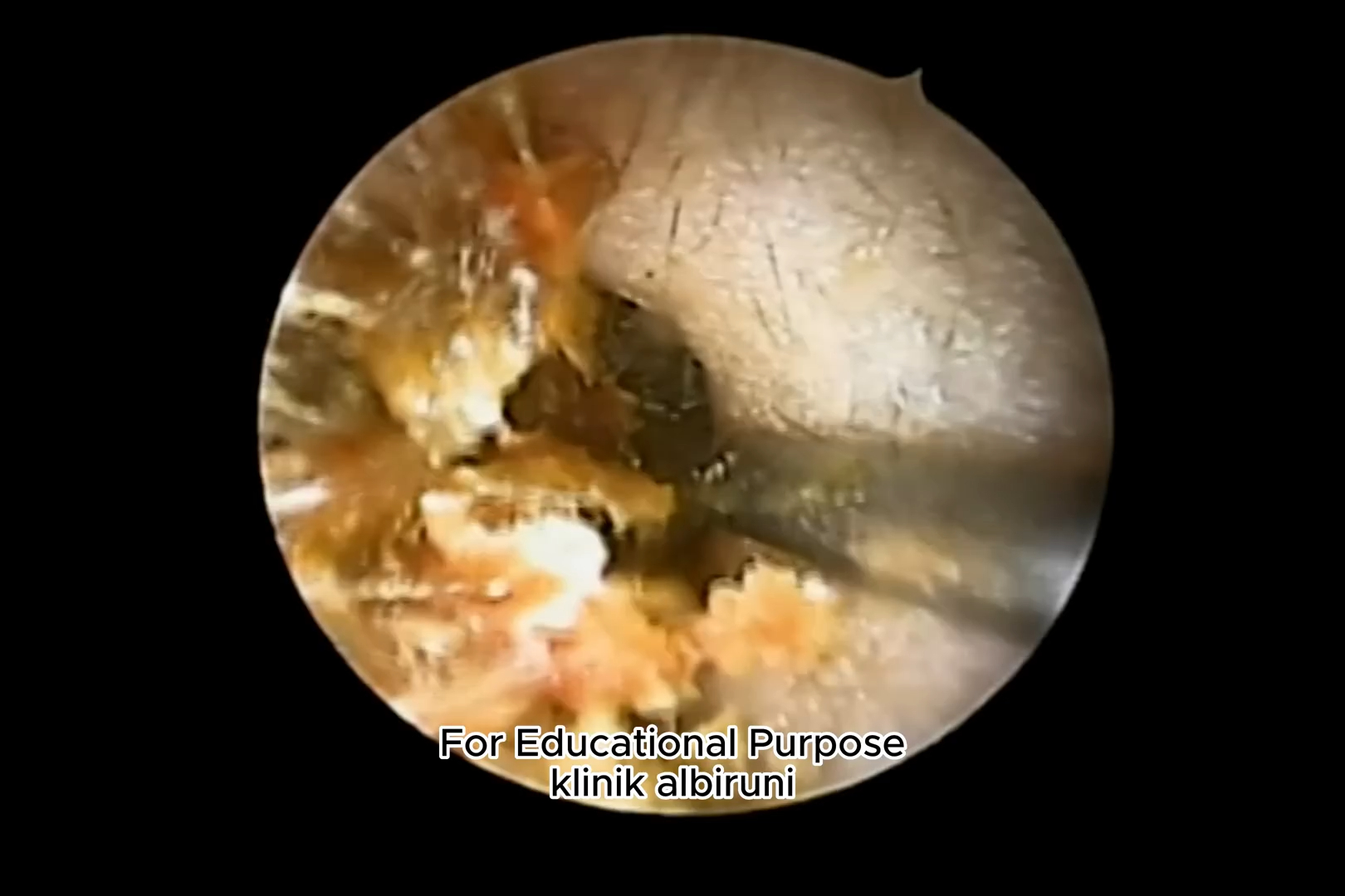 掏耳朵解压-闭孔角化症 - 最糟糕的耳垢