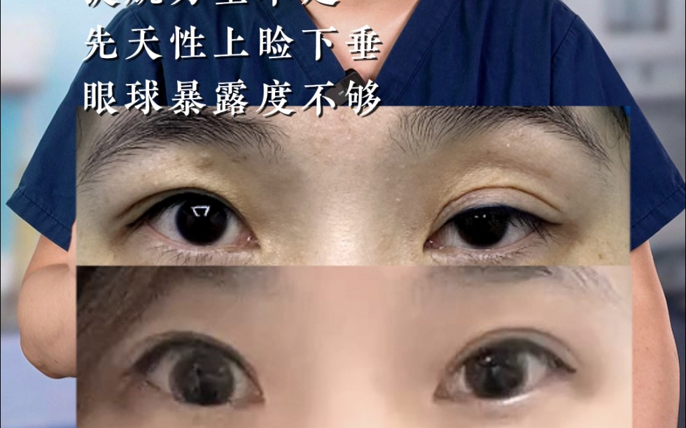 双眼皮修复,改善上睑凹陷,提肌无力.