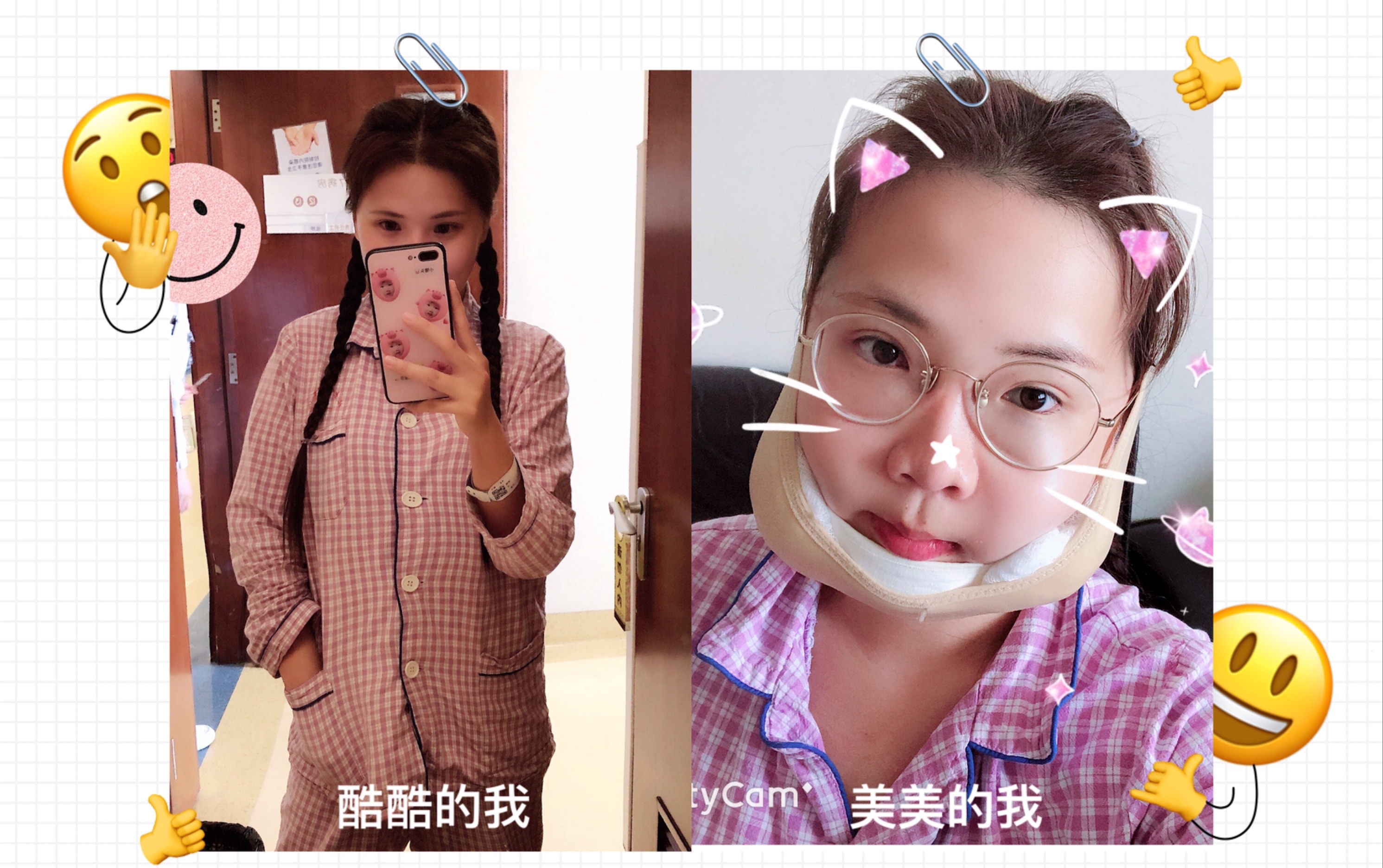 正颌手术后一年七个月拆钛板大夫说我恢复的吵架好