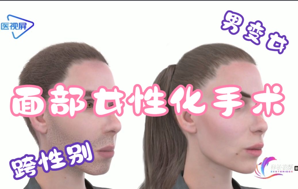 医学3d变性人是如何从阳刚脸变成软妹脸的