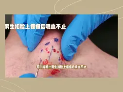 Download Video: 男生挤痘血流不止近1小时，当事人用了400张抽纸，整个脸都苍白了