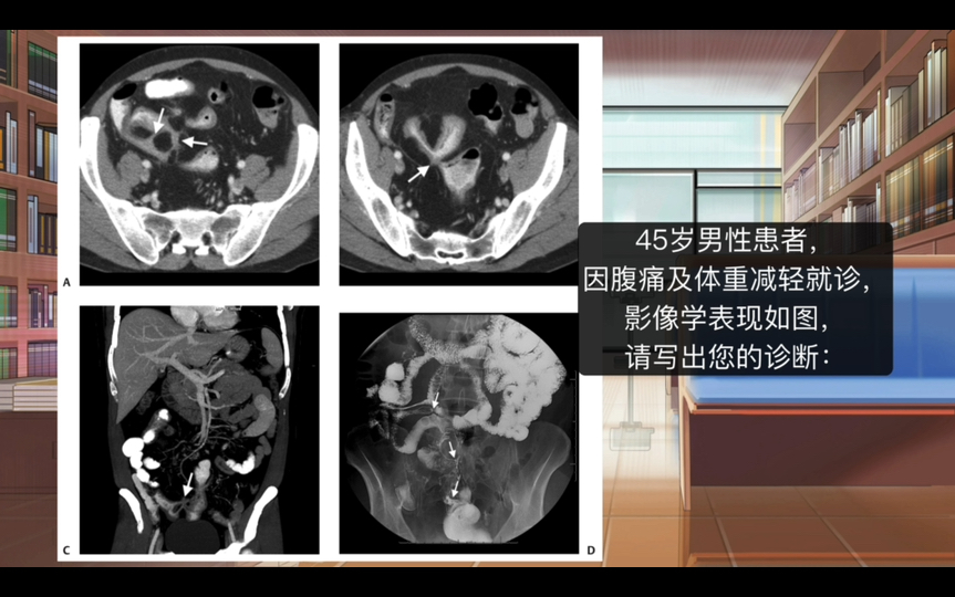 45岁男性患者腹泻和体重减轻,诊断为克罗恩病(Crohn disease)哔哩哔哩bilibili