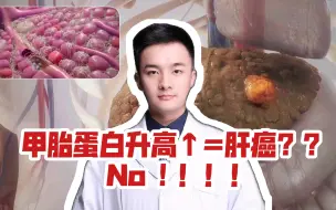 Download Video: 【医生硬核科普】体检发现甲胎蛋白升高↑=肝癌？ 医生告诉你还有这几种情况！不要怕！