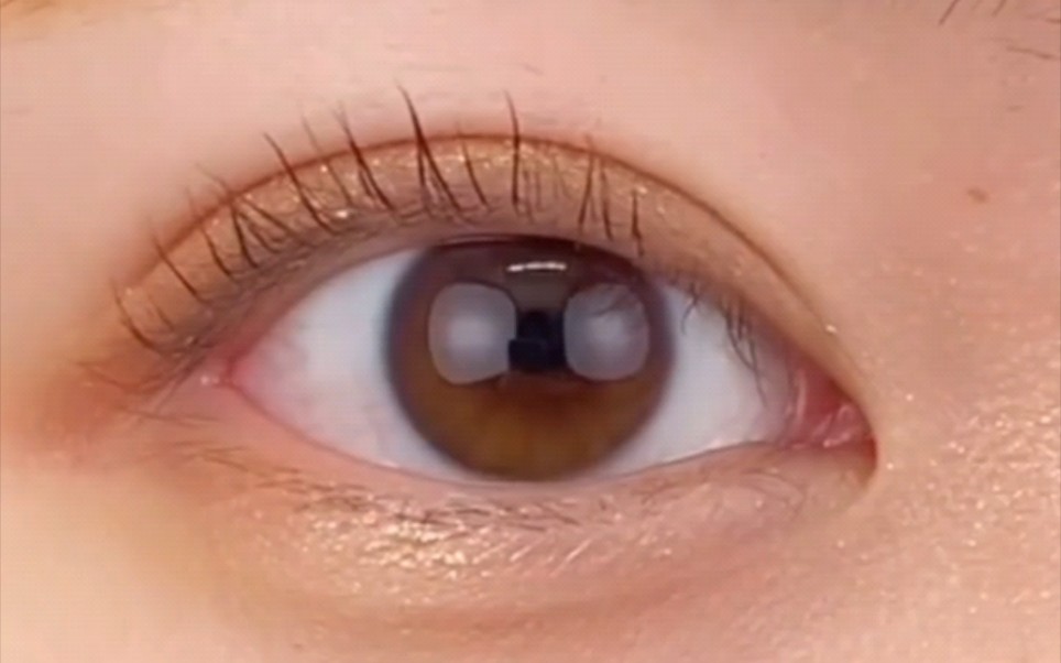 8毫米全切双眼皮 三个月