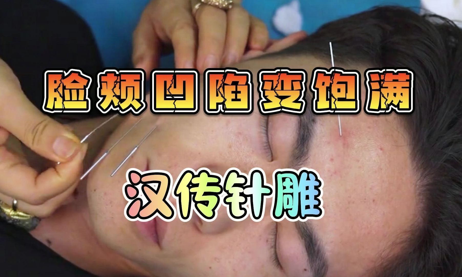 王瑞雪汉传针雕教学 中医美容 针灸美容 医美 整形 抗衰