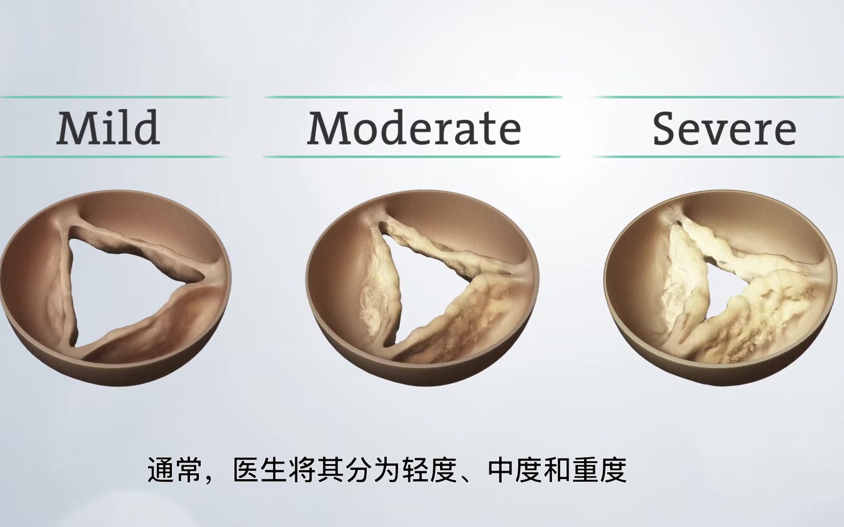 TAVR(经导管主动脉瓣置换术)重度主动脉瓣狭窄 患教科普(已添加中文字幕)哔哩哔哩bilibili