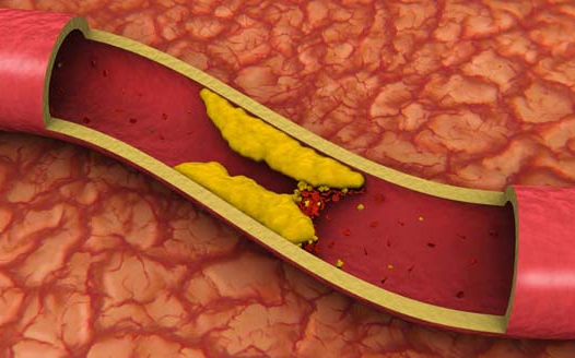 治疗高脂血症的药物总结 to treat hyperlipidemia哔哩哔哩bilibili