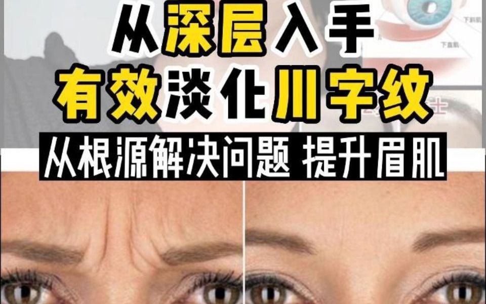 [图]平时经常爱皱眉