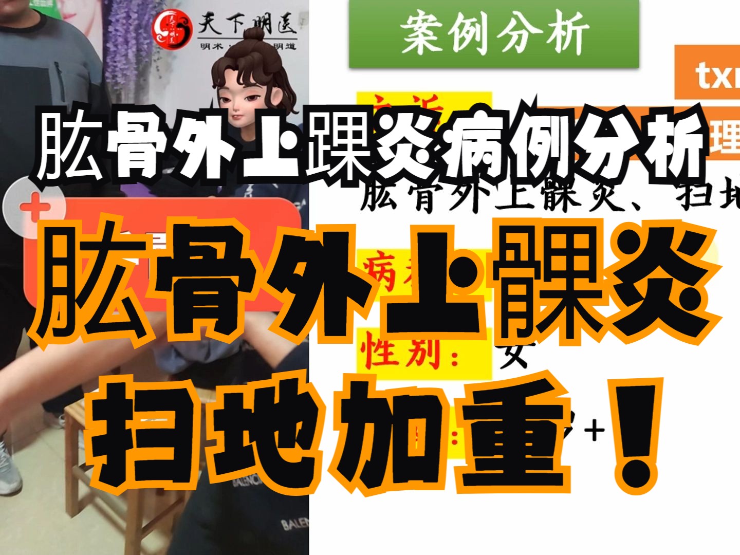 肱骨外上髁炎【病例分析】(肱骨外上髁炎,扫地加重)——使用天下明医