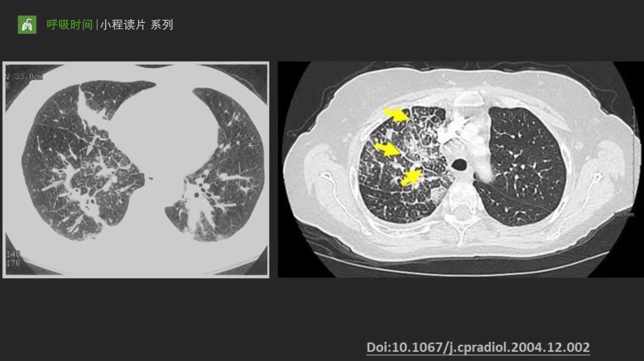 [图]小程读片系列