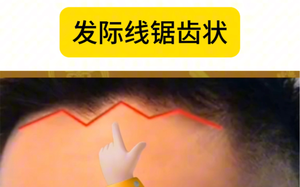 发际线锯齿状代表着什么