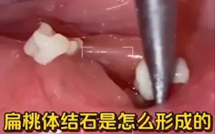 Tải video: 逆天结石，像牙齿一样