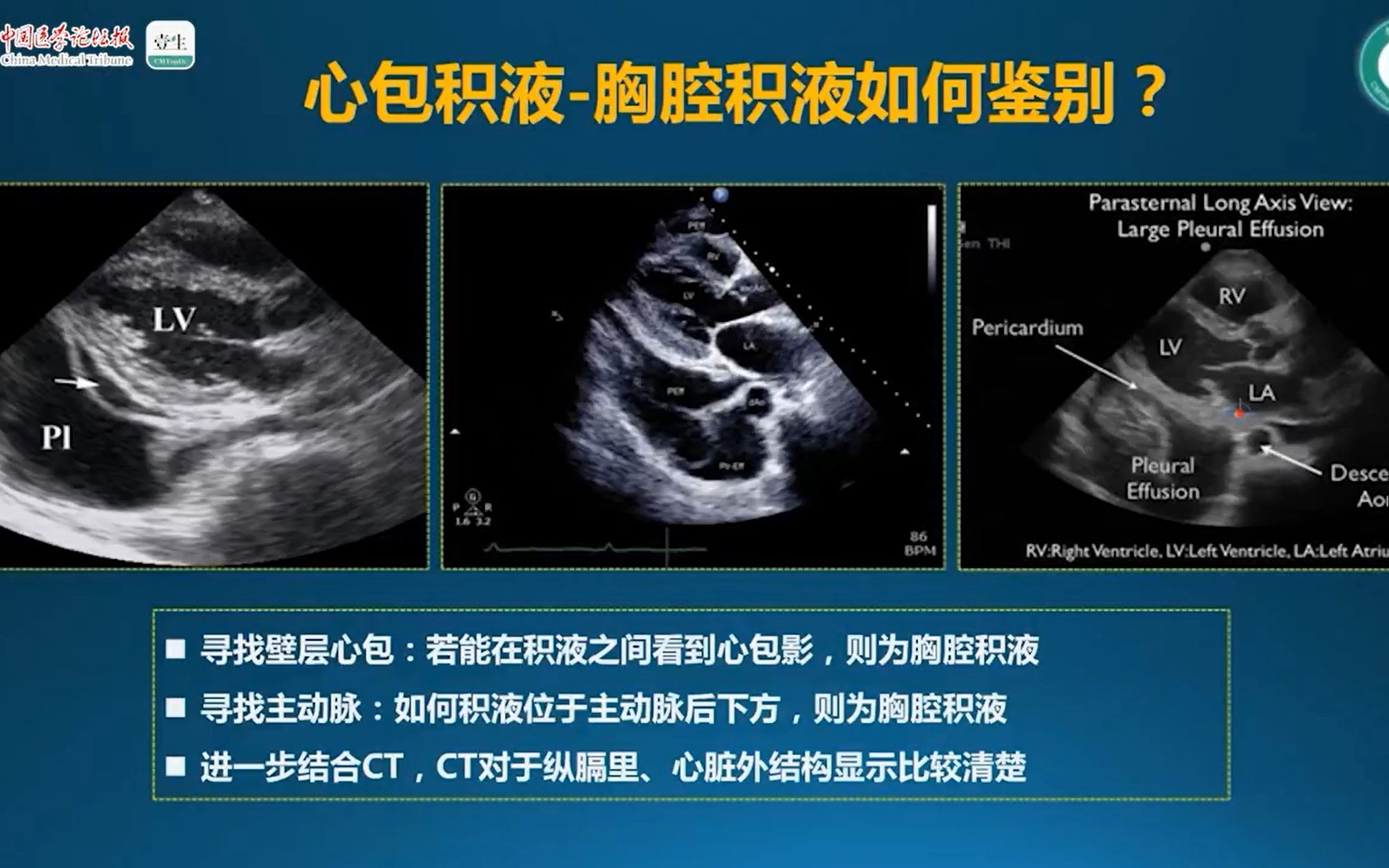 【零基础、手把手教你学心脏超声系列】7. 心包积液的超声心动图诊断哔哩哔哩bilibili