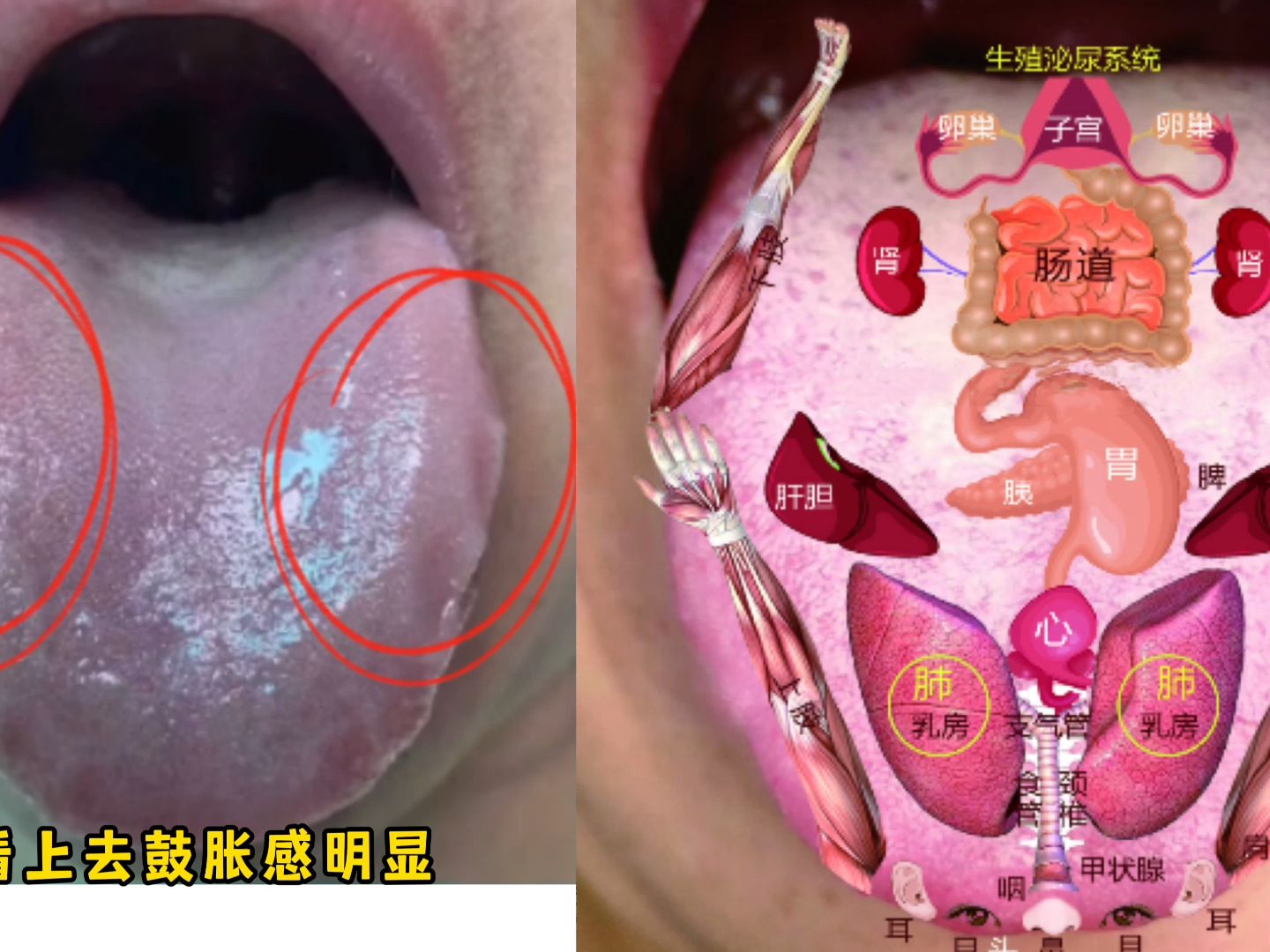 舌诊分析:舌苔白腻,舌质暗紫,肝郁脾虚兼有肾虚血瘀